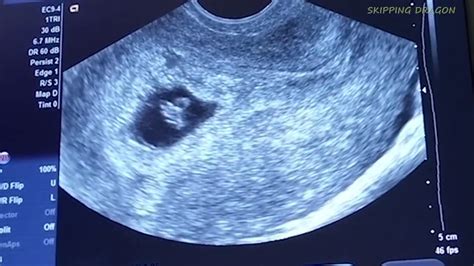 This happened to one of our readers recently. . No heartbeat at 8 weeks successful pregnancy